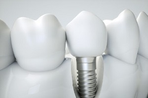 Dental İmplant