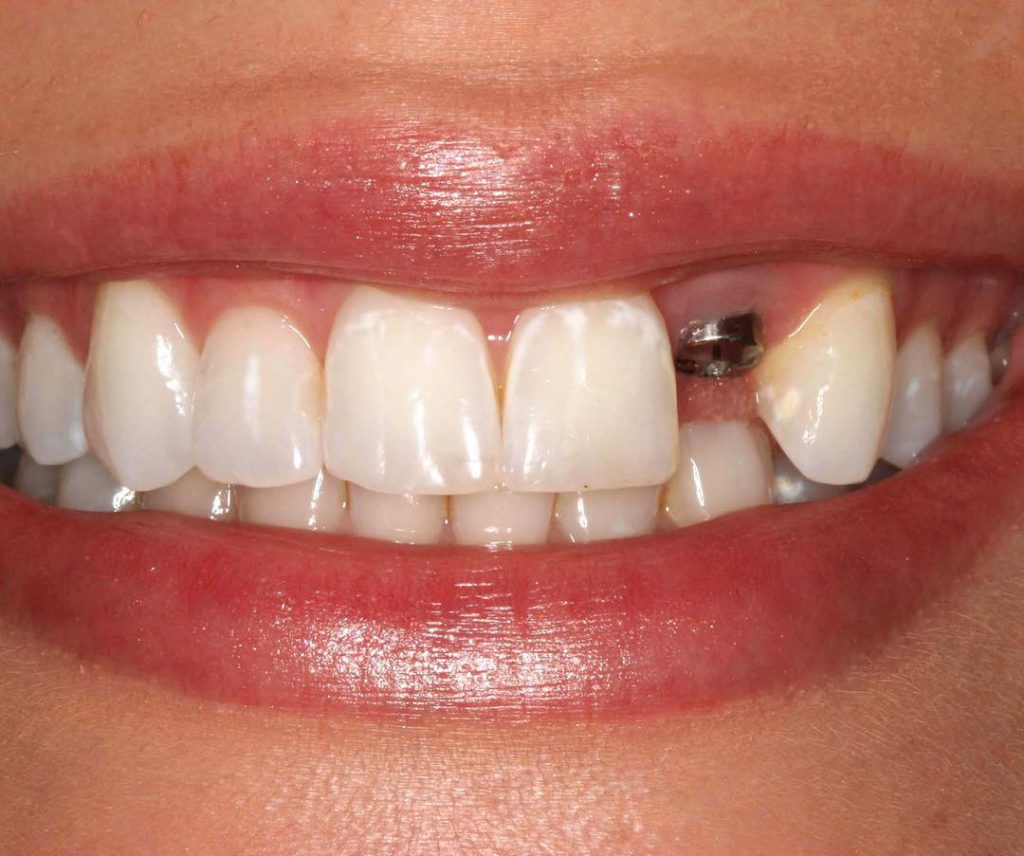 Diş İmplantı Tedavi Süresi