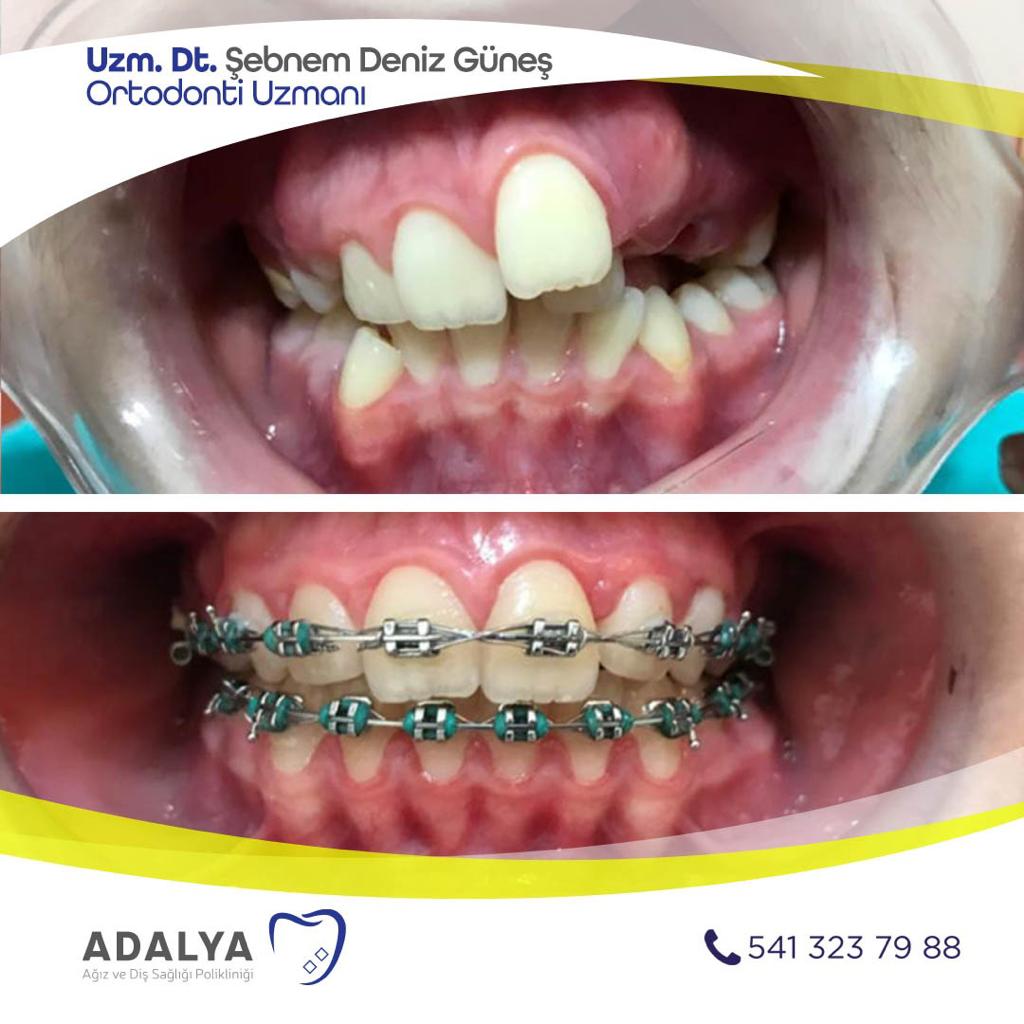 Ortodonti Antalya