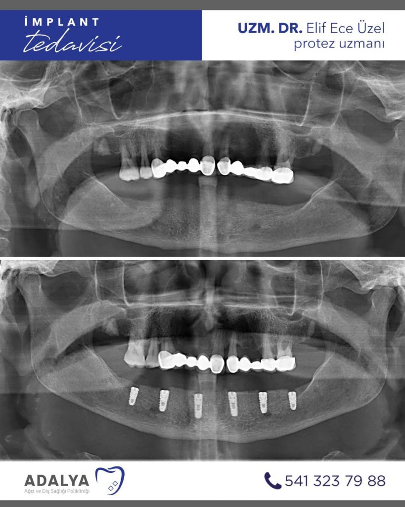 antalya diş klinikleri