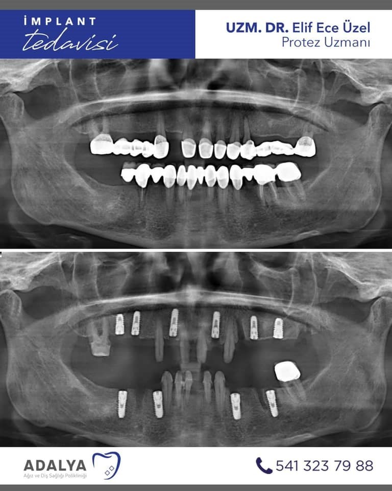 dosemealti implant dis klinigi antalya